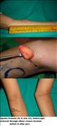Before After Pictures,Cosmetic surgery,Delhi,endoscopic lipoma forearm removal 